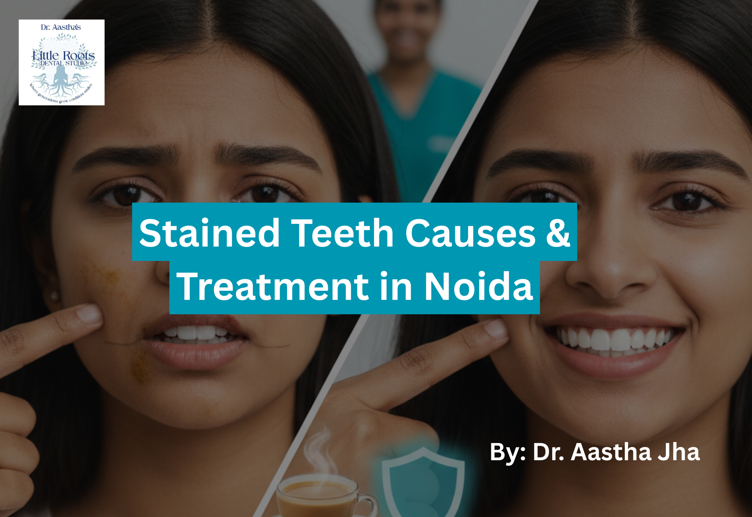 Teeth Discoloration Treatment In Noida